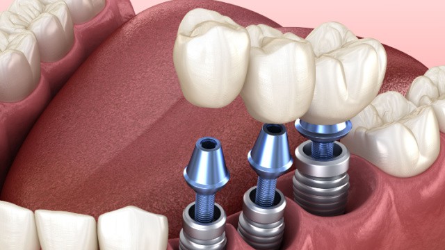 prix des implants dentaires