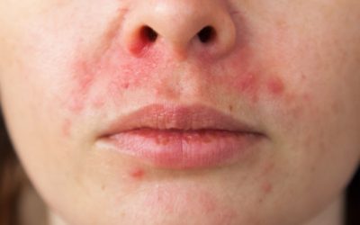 Wat is dermatitis perioralis en hoe behandelen?