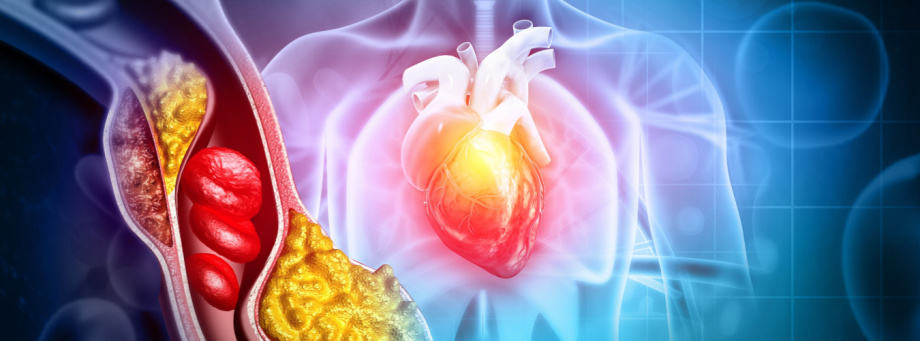 https://www.shutterstock.com/image-illustration/cholesterol-blocked-artery-heart-3d-illustration-2079146449